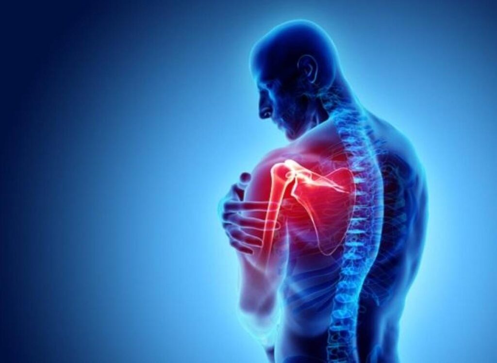 Femme souffrant de douleur à l'épaule illustrant une tendinopathie calcifiante