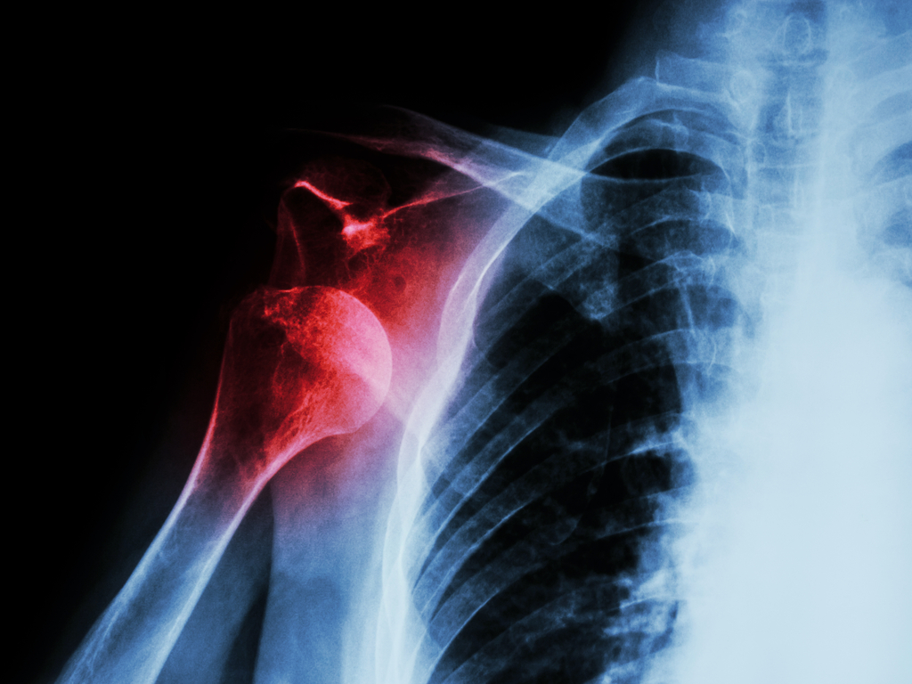Radiographie des calcifications de l'épaule