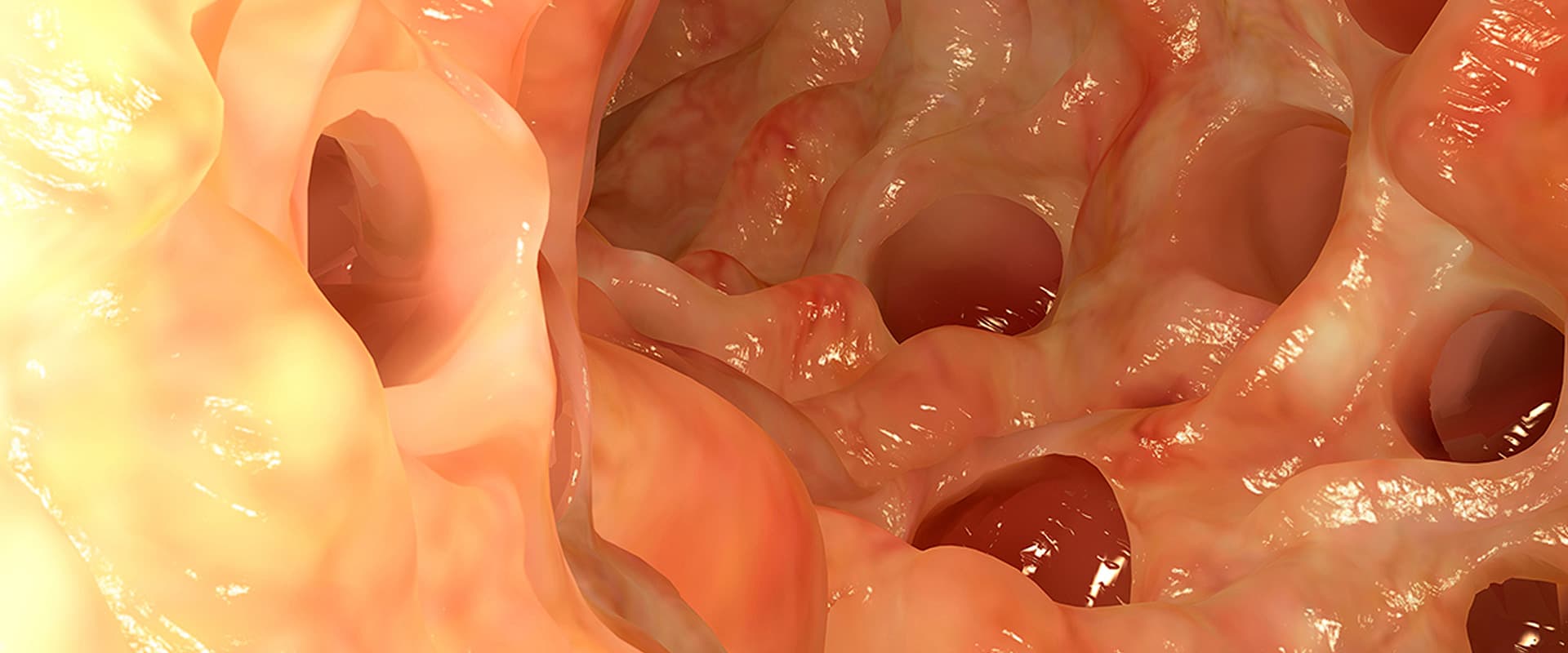 Schéma montrant une diverticulite dans les intestins