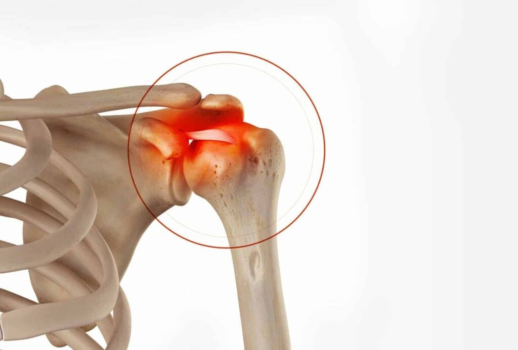 Calcification de l’épaule : existe-t-il un lien avec le cancer ?