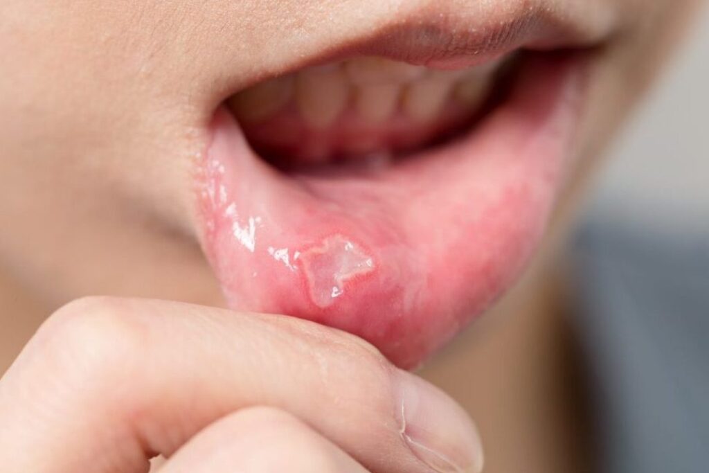Traitement aphte en pharmacie : quelles options sont disponibles ?