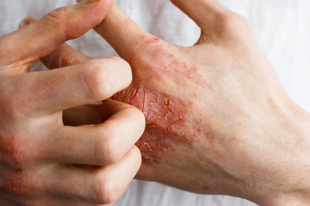 Eczéma et émotions : quelle signification psychosomatique ?