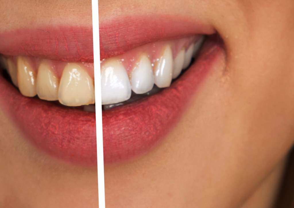 Comment enlever une tache jaune sur une dent de devant ?