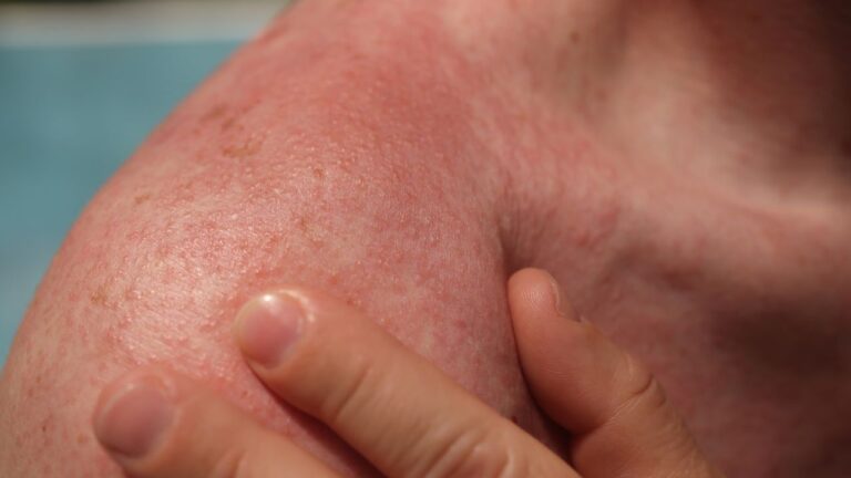Femme touchée par une allergie au soleil avec peau rougie en extérieur