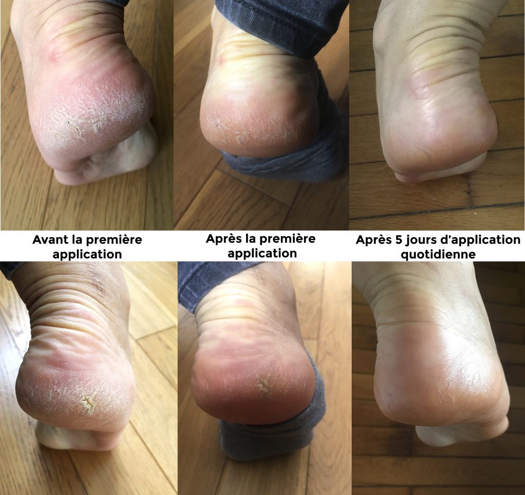 Baume naturel pour pieds corne