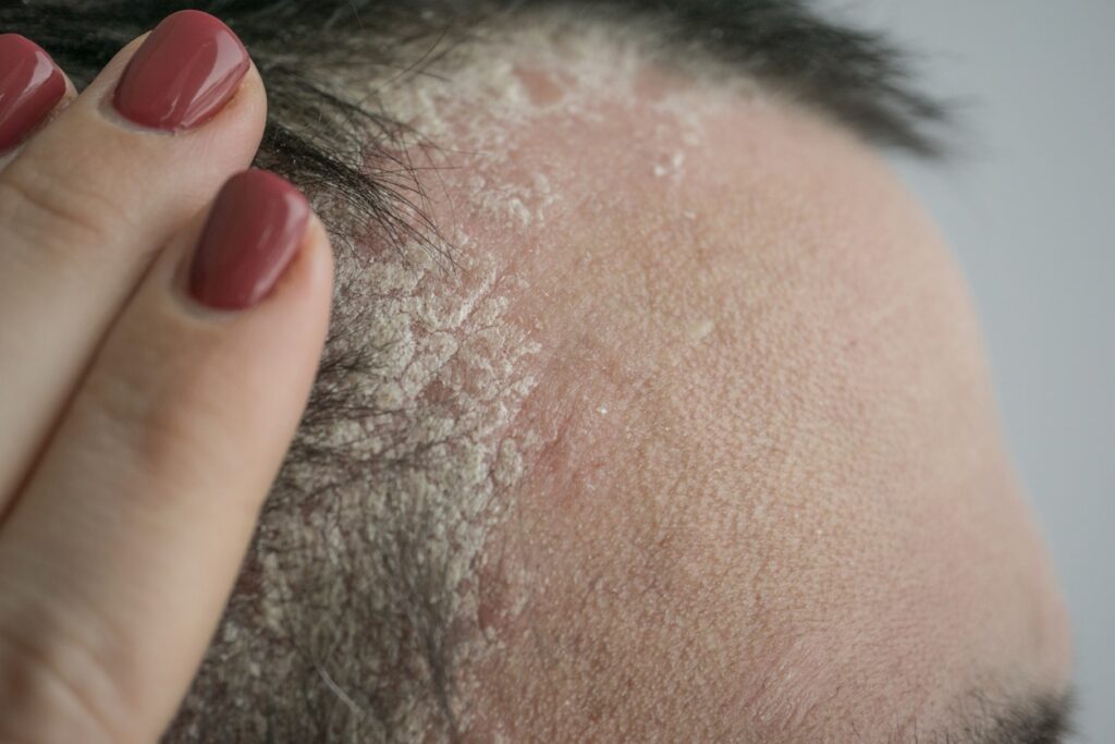 Remède de grand-mère naturel appliqué sur le cuir chevelu pour traiter les boutons