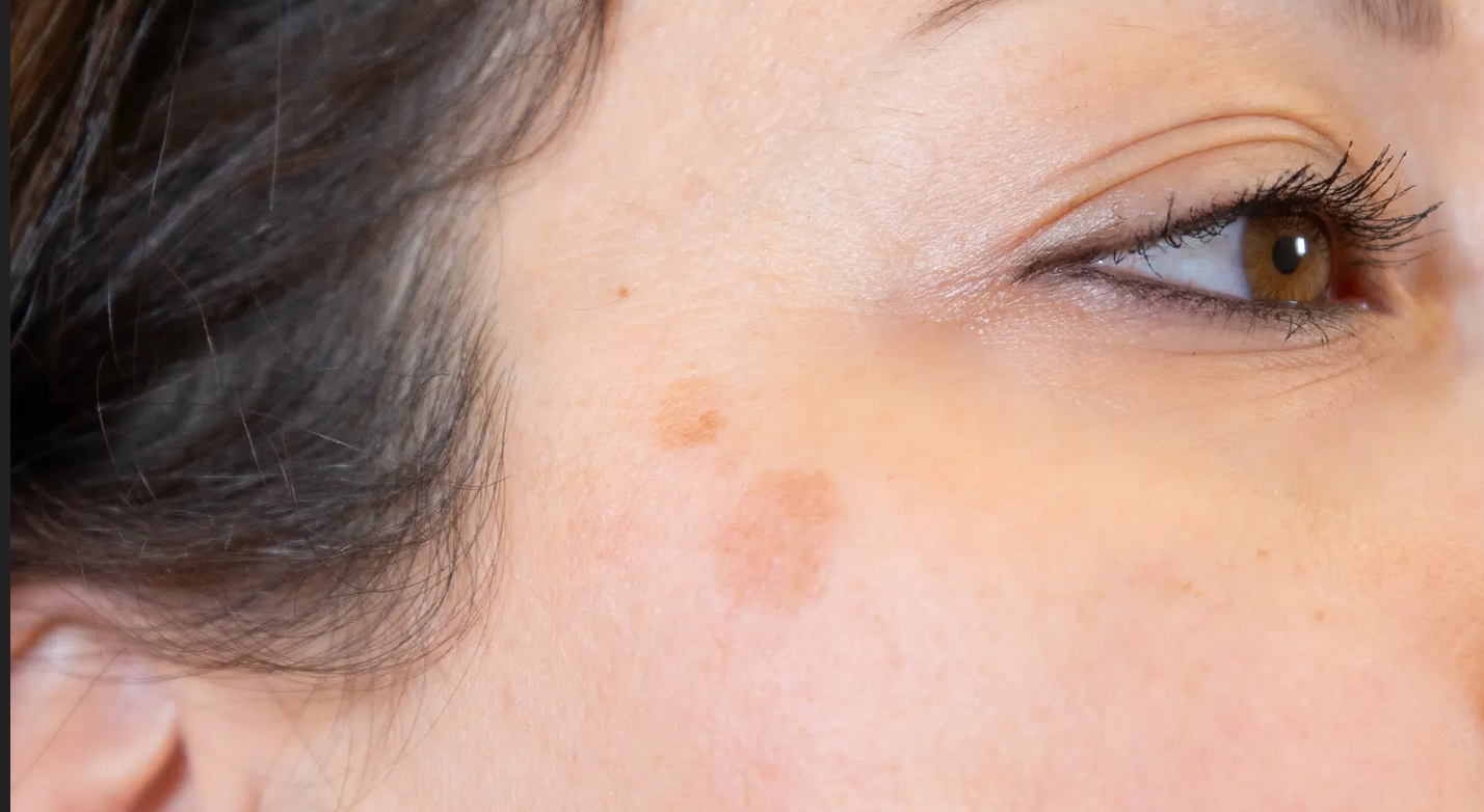 remede naturel taches brunes