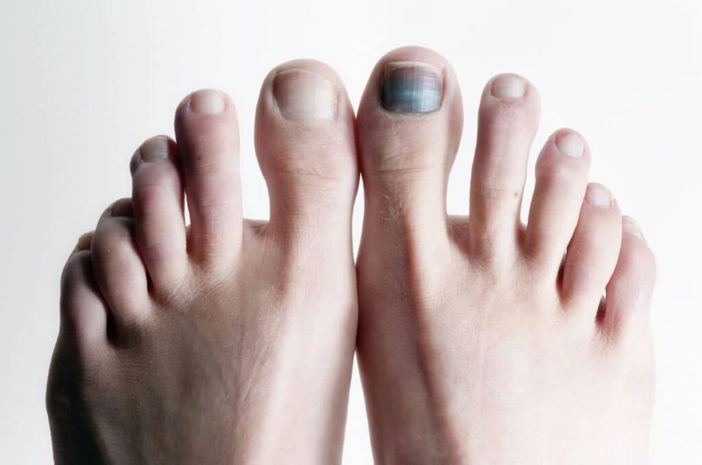 Ongle noir sur un orteil avec rougeur : illustration d'un problème courant traité par des remèdes de grand-mère