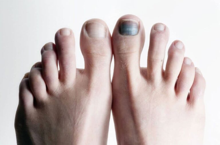 Ongle noir sur un orteil avec rougeur : illustration d'un problème courant traité par des remèdes de grand-mère