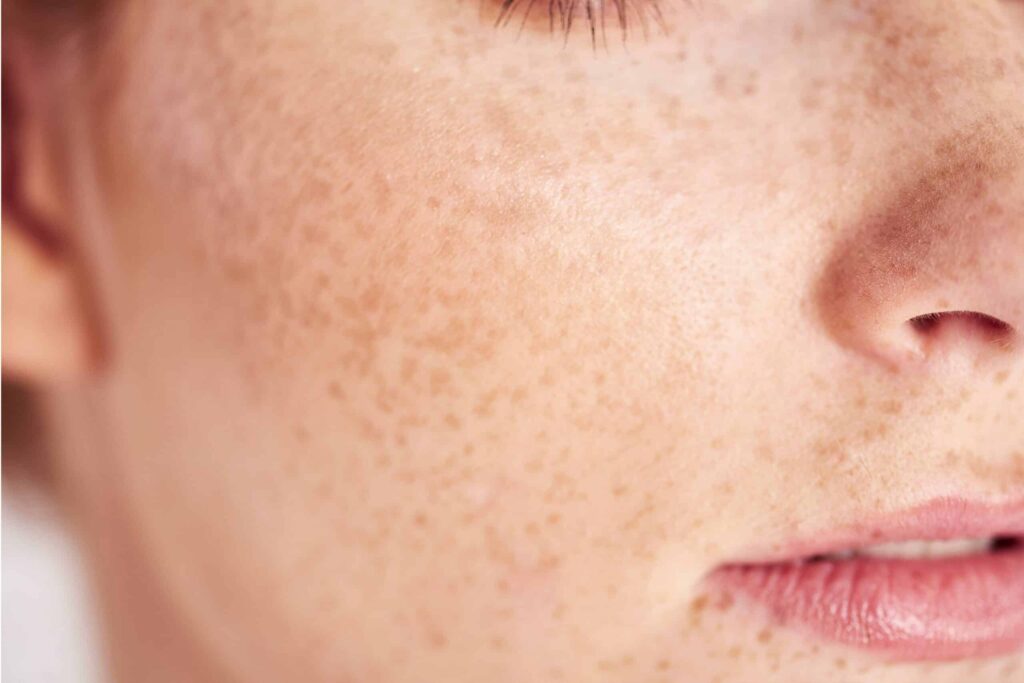 Femme montrant des taches brunes sur le visage avant un traitement dermatologique
