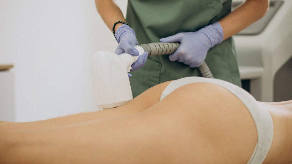 Comment le coolsculpting peut remodeler votre silhouette ?